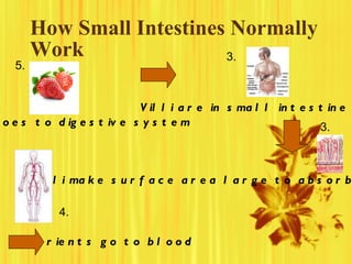 How Small Intestines Normally Work 3. Villi make surface area large to absorb nutrients 3. Food goes to digestive system N...