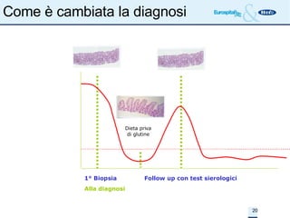 Come è cambiata la diagnosi 1° Biopsia    Follow up con test sierologici   Alla diagnosi Dieta priva di glutine 1° Biopsia  2° Biop.  3° Biop .  Tempo 0  6 mesi  anche 1 anno  Challenge con Glutine Dieta priva di glutine Livello Anticorpi Test Positivo Test Negativo 
