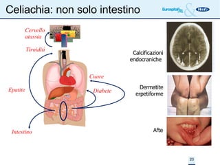 Celiachia: non solo intestino Afte  Calcificazioni endocraniche  Dermatite erpetiforme Cervello atassia Tiroiditi Diabete Cuore Intestino Epatite 