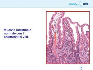 Mucosa intestinale normale con i caratteristici villi. 