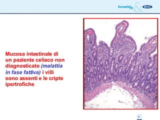 Mucosa intestinale di un paziente celiaco non diagnosticato  (malattia in fase fattiva)   i villi sono assenti e le cripte ipertrofiche 