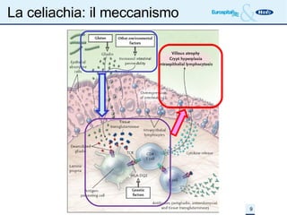 La celiachia: il meccanismo 