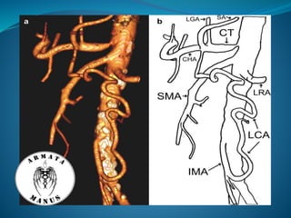 Celiac trunk anatomy