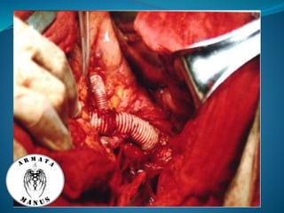 Celiac trunk anatomy