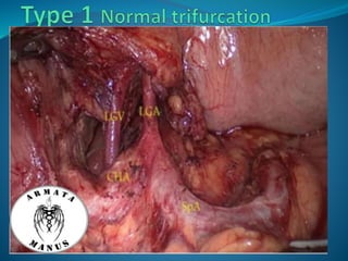 Celiac trunk anatomy