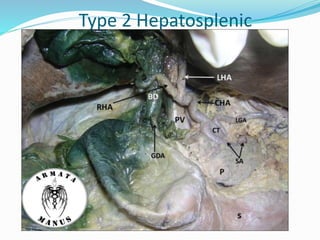 Type 2 Hepatosplenic
 