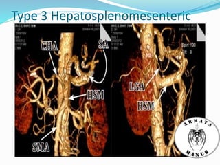 Type 3 Hepatosplenomesenteric
 