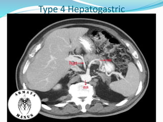 Type 4 Hepatogastric
 