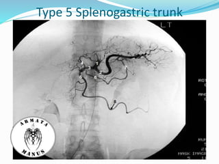 Type 5 Splenogastric trunk
 