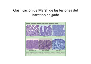 Clasificación de Marsh de las lesiones del
             intestino delgado
 