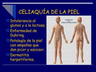 CELIAQUÍA DE LA PIEL
 Intolerancia al
gluten y a la lactosa.
 Enfermedad de
Duhring.
 Patología de la piel
con ampollas que
dan picor y escozor.
 Dermatitis
herpetiforme.
 