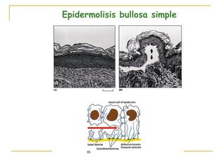 Epidermolisis bullosa simple
 