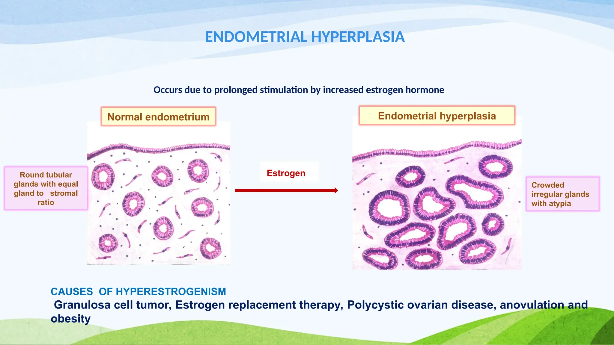 ENDOMETRIAL HYPERPLASIA
Occurs due to prolonged stimulation by increased estrogen hormone
CAUSES OF HYPERESTROGENISM
Granulosa cell tumor, Estrogen replacement therapy, Polycystic ovarian disease, anovulation and
obesity
Estrogen
Crowded
irregular glands
with atypia
Round tubular
glands with equal
gland to stromal
ratio
Normal endometrium Endometrial hyperplasia
 