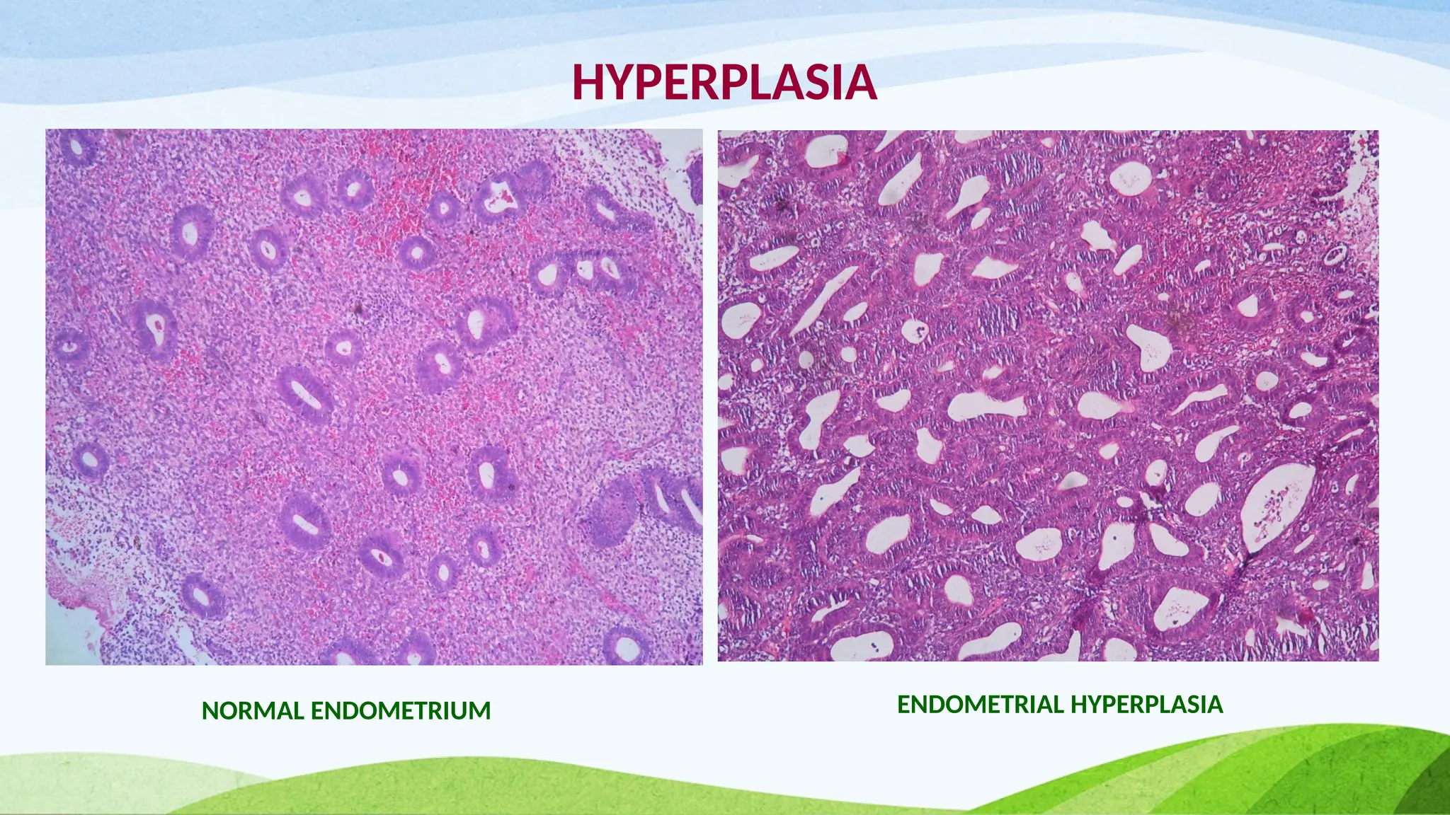 HYPERPLASIA
NORMAL ENDOMETRIUM ENDOMETRIAL HYPERPLASIA
 