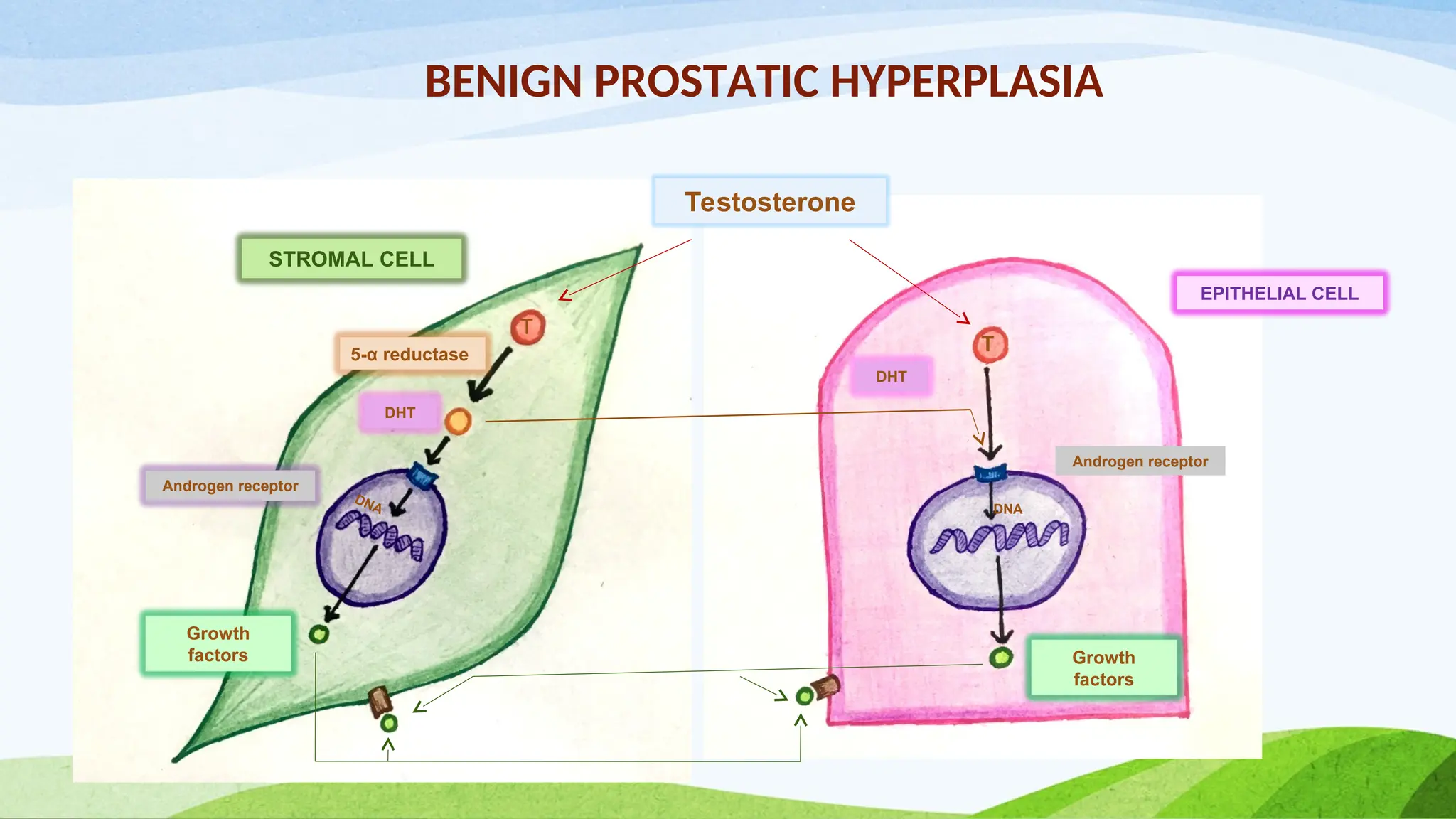 BENIGN PROSTATIC HYPERPLASIA
T
T
Testosterone
DHT
5-α reductase
Androgen receptor
Androgen receptor
DNA
DNA
Growth
factors Growth
factors
STROMAL CELL
EPITHELIAL CELL
DHT
 