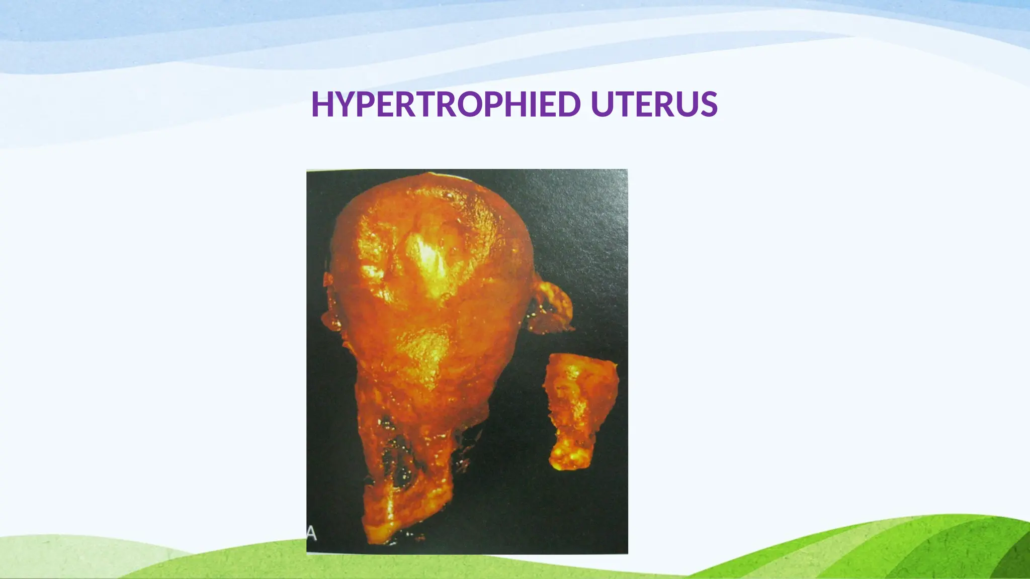 HYPERTROPHIED UTERUS
 