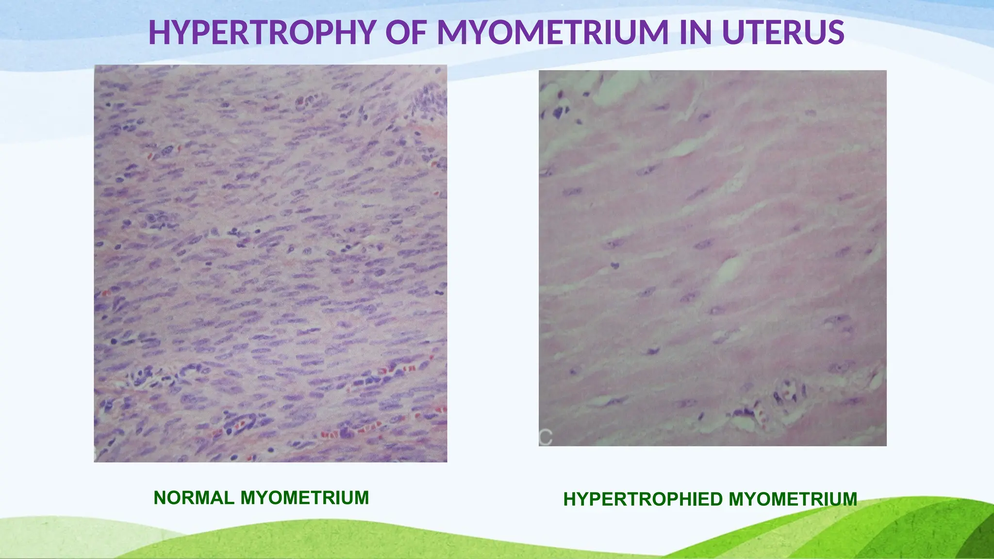 HYPERTROPHY OF MYOMETRIUM IN UTERUS
NORMAL MYOMETRIUM HYPERTROPHIED MYOMETRIUM
 