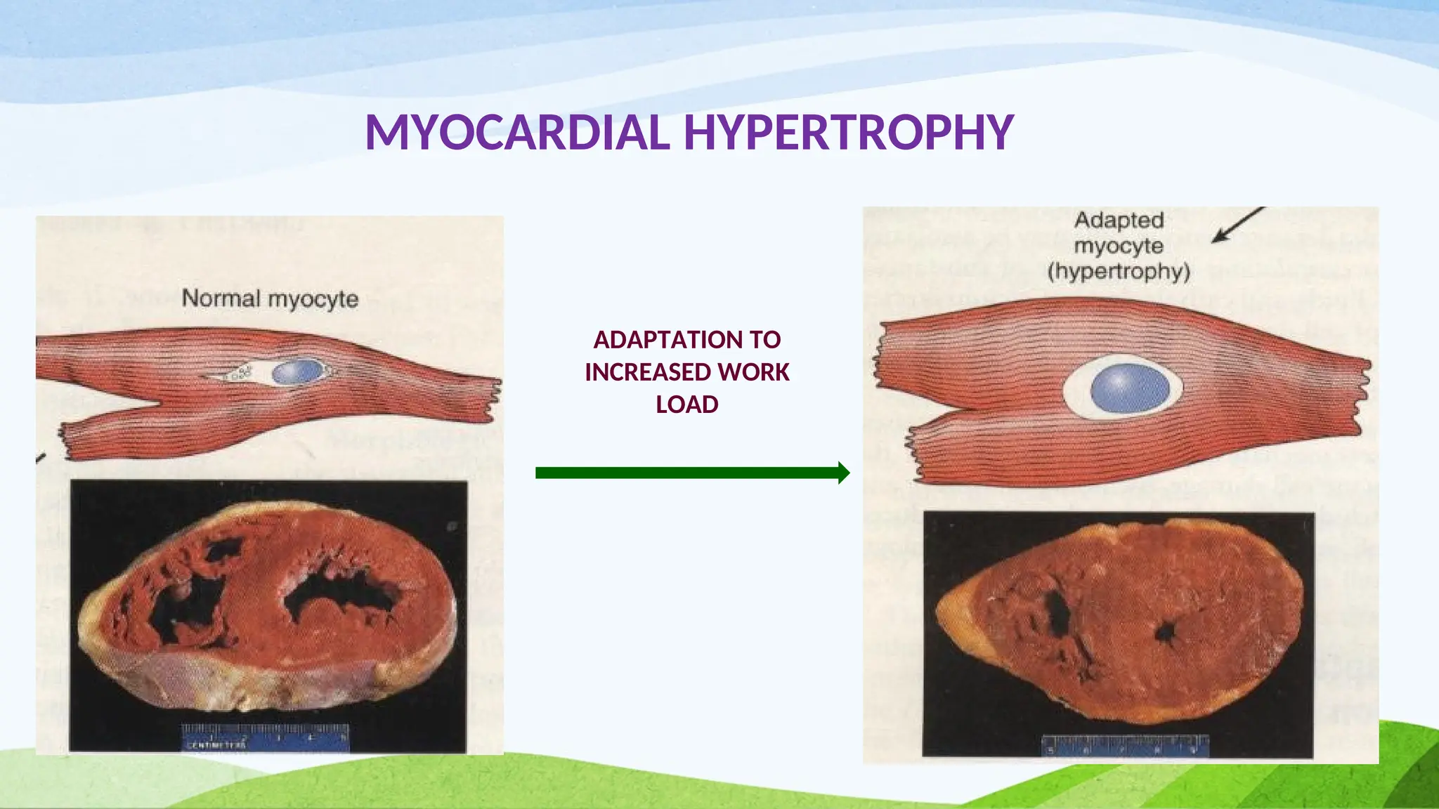 MYOCARDIAL HYPERTROPHY
ADAPTATION TO
INCREASED WORK
LOAD
 