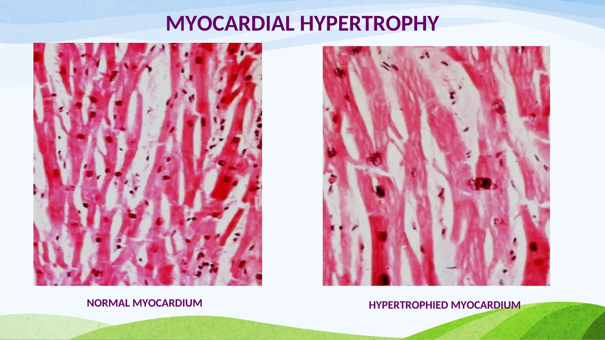 MYOCARDIAL HYPERTROPHY
NORMAL MYOCARDIUM HYPERTROPHIED MYOCARDIUM
 