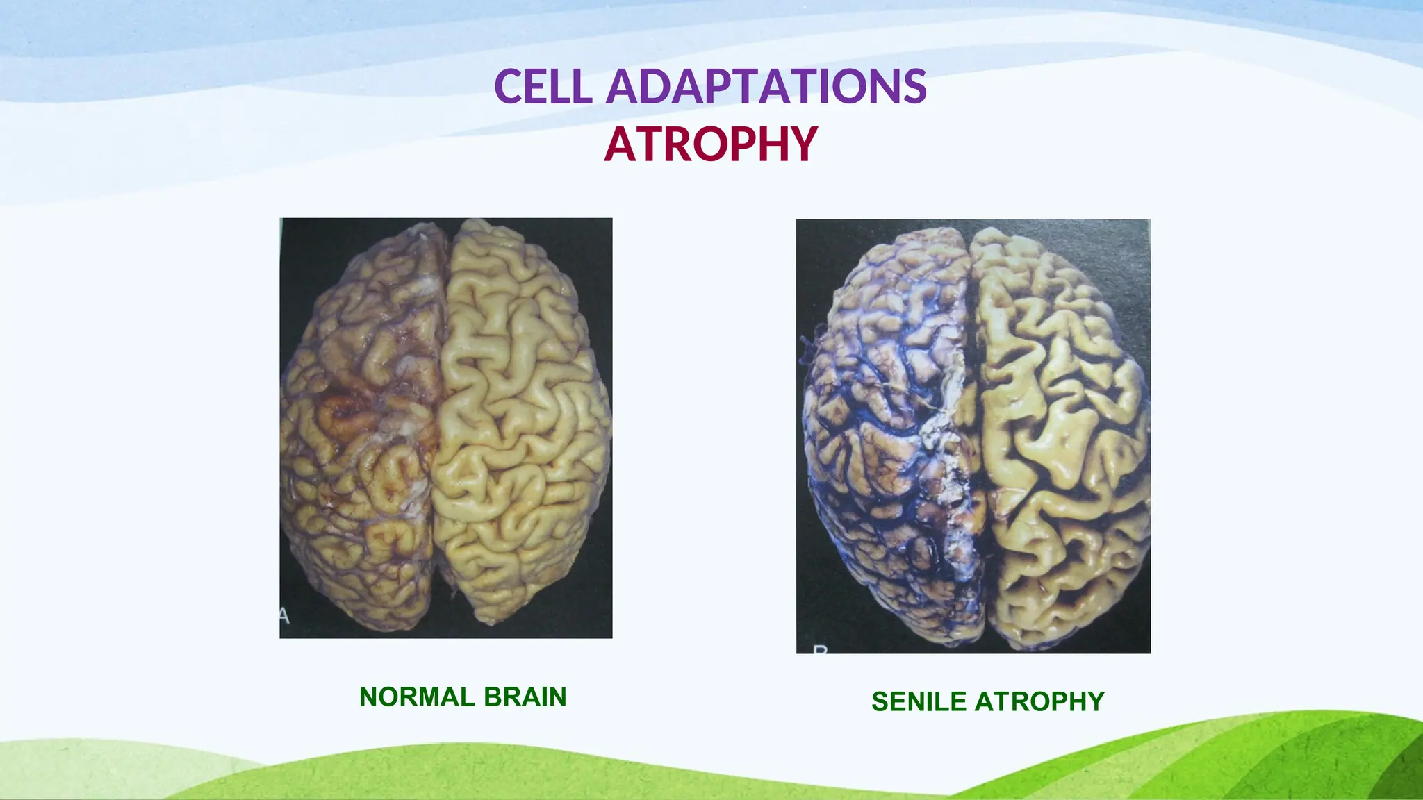 CELL ADAPTATIONS
ATROPHY
NORMAL BRAIN SENILE ATROPHY
 