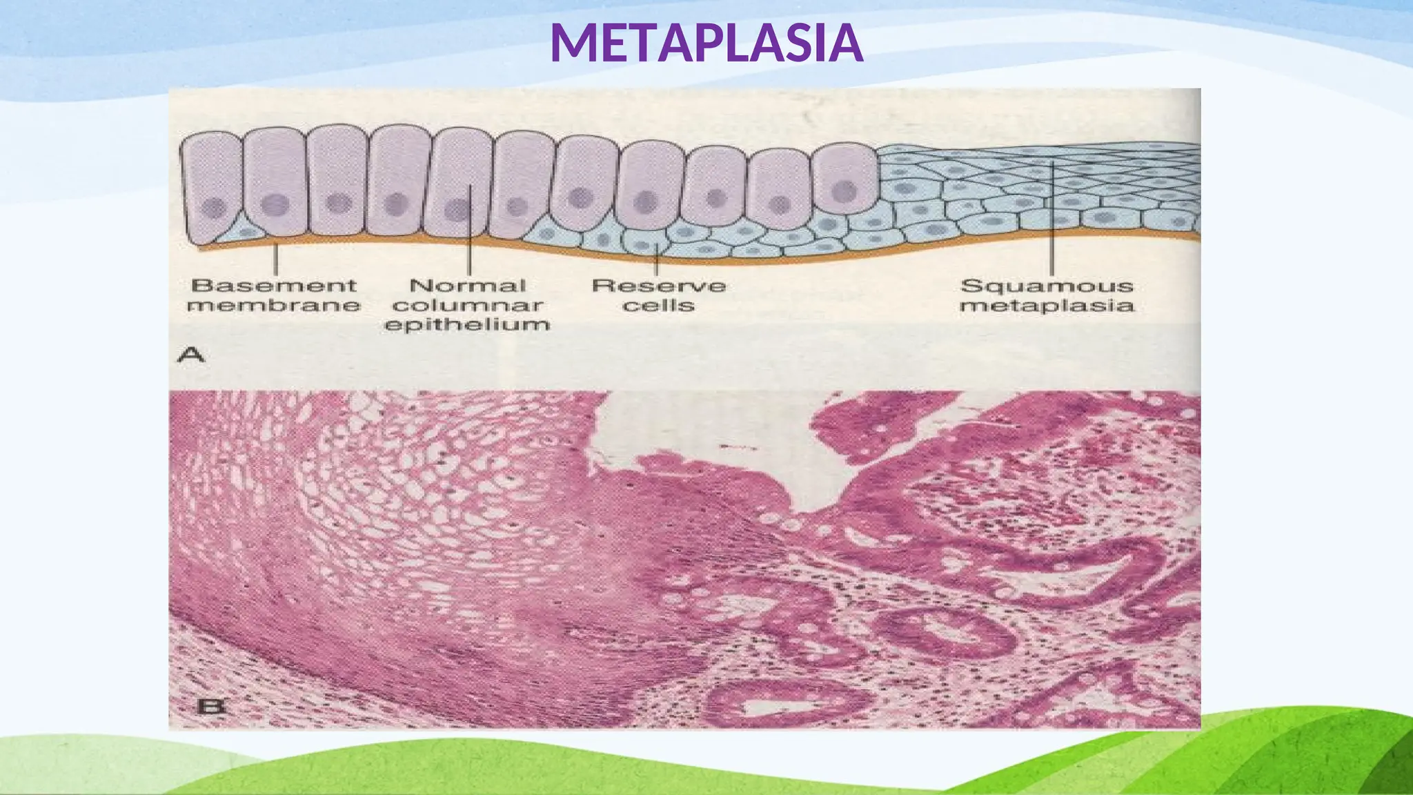 METAPLASIA
 