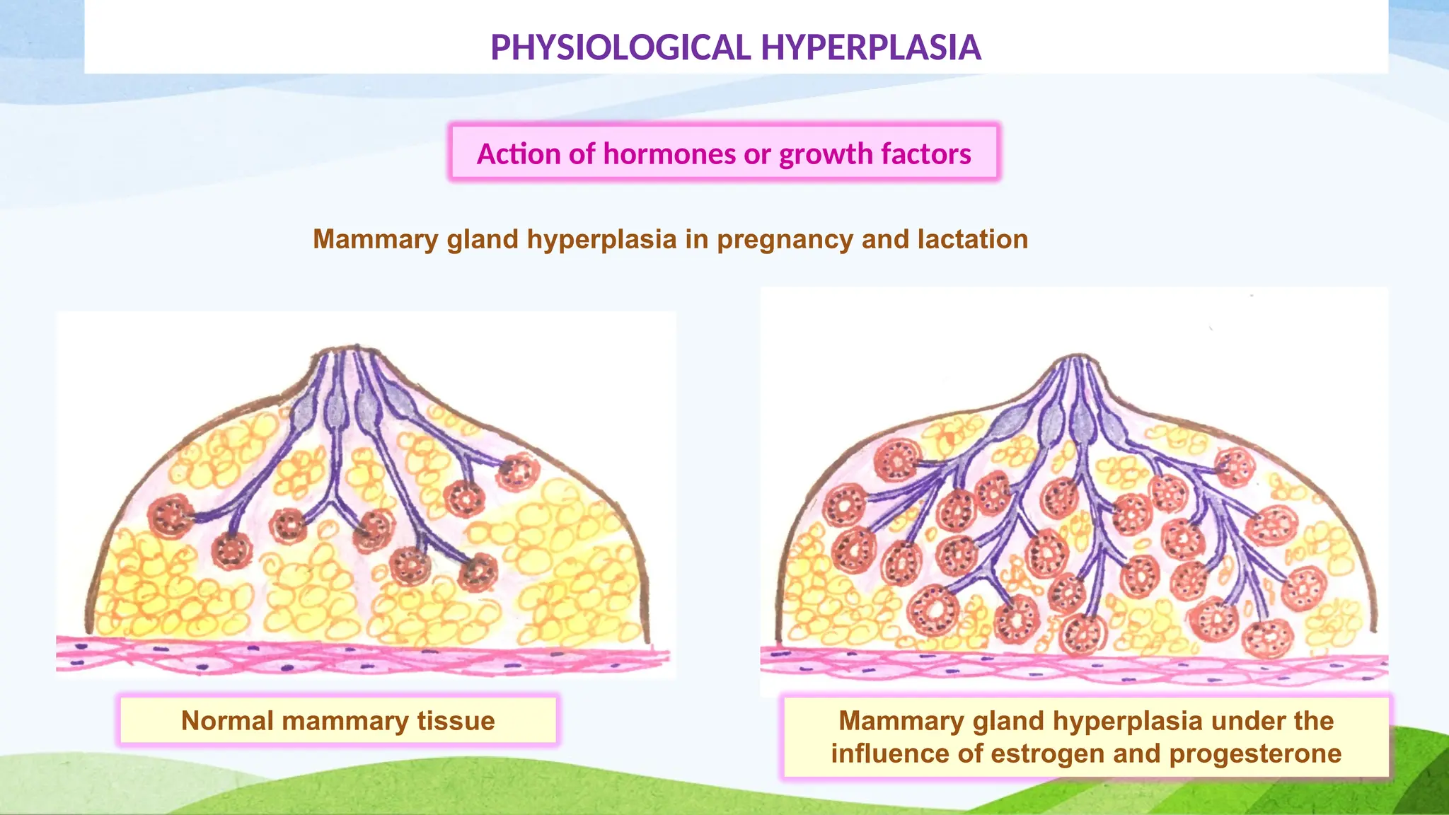 PHYSIOLOGICAL HYPERPLASIA
Action of hormones or growth factors
Mammary gland hyperplasia in pregnancy and lactation
Normal mammary tissue Mammary gland hyperplasia under the
influence of estrogen and progesterone
 