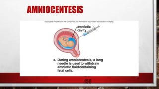 24-
150
AMNIOCENTESIS
 