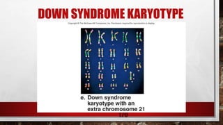 24-
170
DOWN SYNDROME KARYOTYPE
 