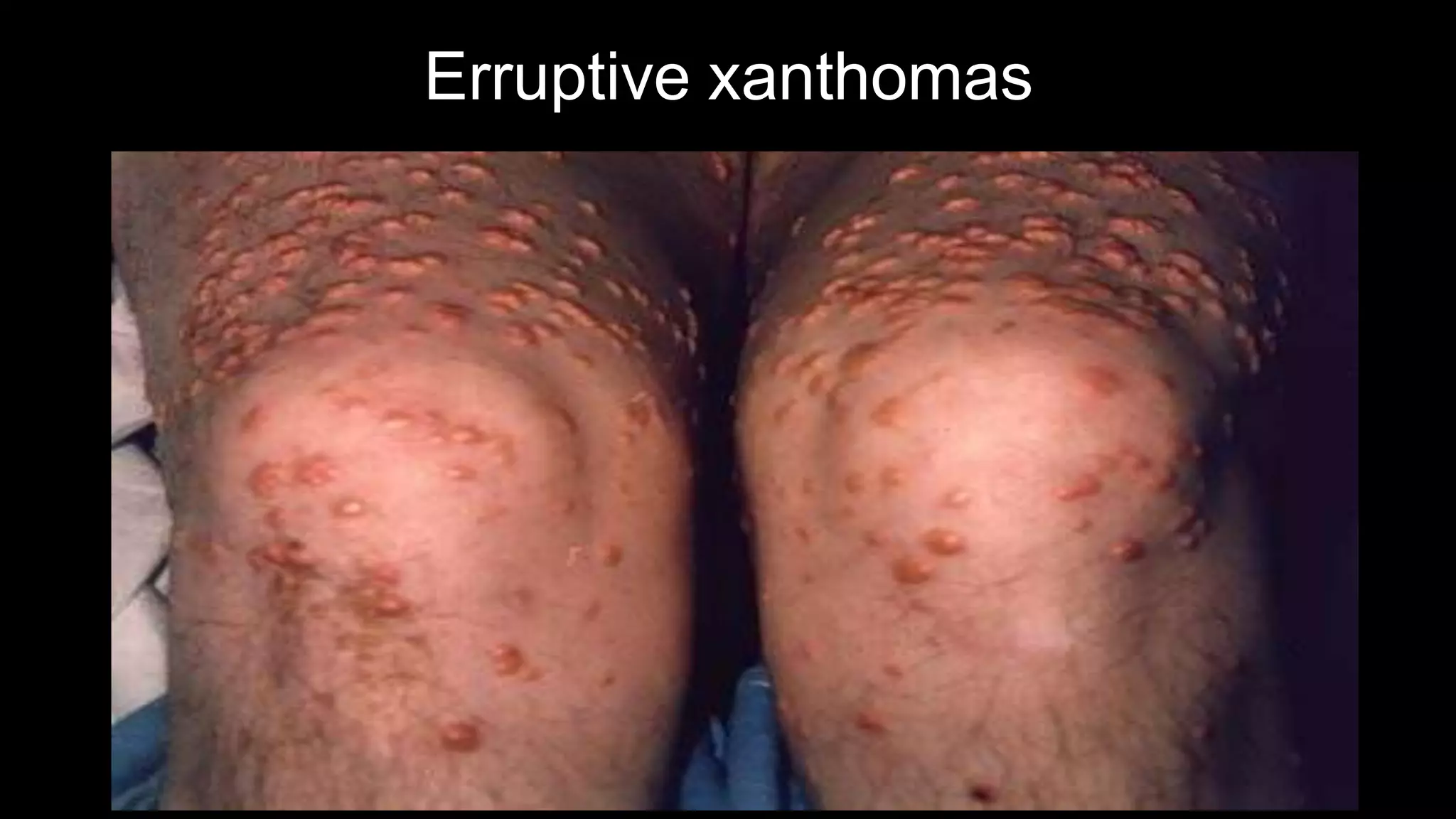 Erruptive xanthomas
 