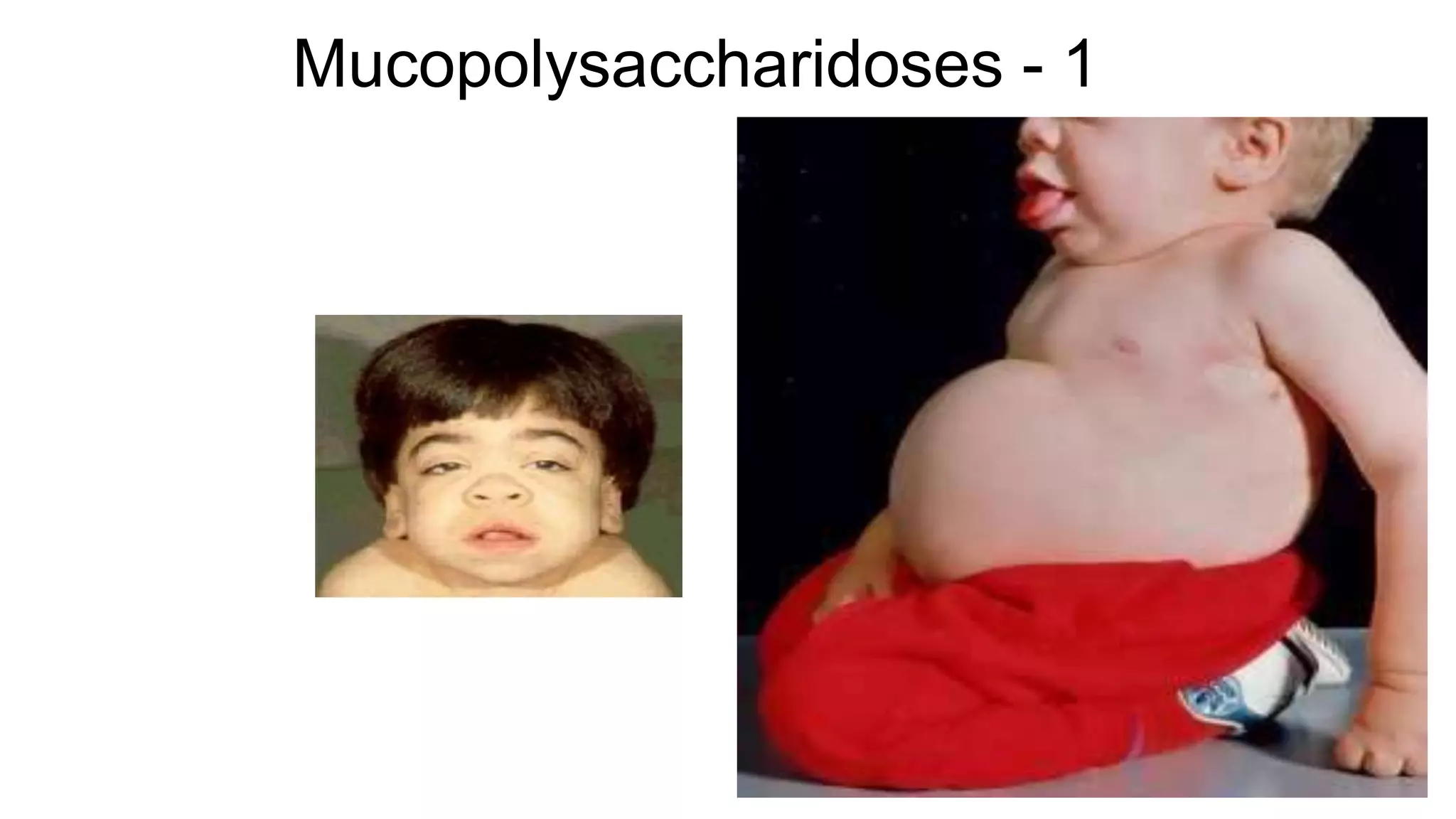 Mucopolysaccharidoses - 1
 