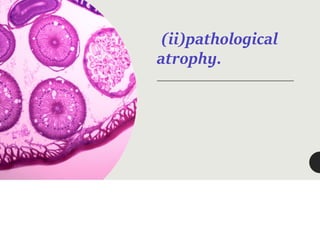 (ii)pathological
atrophy.
 