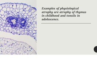Examples of physiological
atrophy are atrophy of thymus
in childhood and tonsils in
adolescence.
 