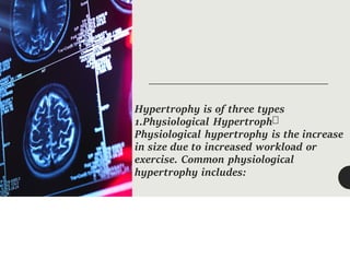 Hypertrophy is of three types
1.Physiological Hypertroph
Physiological hypertrophy is the increase
in size due to increased workload or
exercise. Common physiological
hypertrophy includes:
 