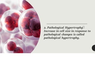 2. Pathological Hypertrophy
Increase in cell size in response to
pathological changes is called
pathological hypertrophy.
 
