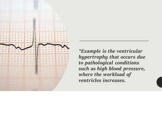 *Example is the ventricular
hypertrophy that occurs due
to pathological conditions
such as high blood pressure,
where the workload of
ventricles increases.
 