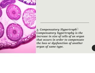 3. Compensatory Hypertroph
Compensatory hypertrophy is the
increase in size of cells of an organ
that occurs in order to compensate
the loss or dysfunction of another
organ of same type.
 