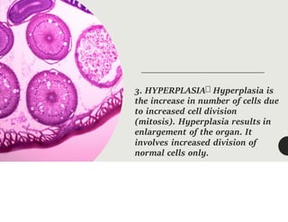 3. HYPERPLASIA Hyperplasia is
the increase in number of cells due
to increased cell division
(mitosis). Hyperplasia results in
enlargement of the organ. It
involves increased division of
normal cells only.
 