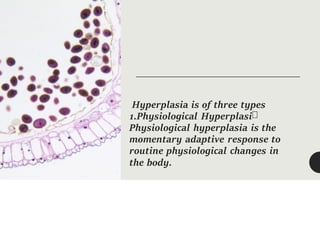 Hyperplasia is of three types
1.Physiological Hyperplasi
Physiological hyperplasia is the
momentary adaptive response to
routine physiological changes in
the body.
 