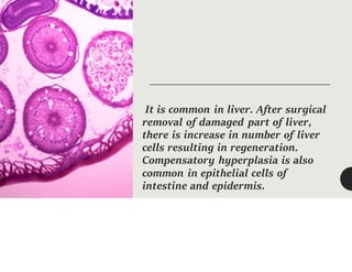 It is common in liver. After surgical
removal of damaged part of liver,
there is increase in number of liver
cells resulting in regeneration.
Compensatory hyperplasia is also
common in epithelial cells of
intestine and epidermis.
 
