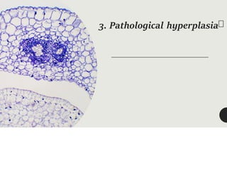 3. Pathological hyperplasia
 