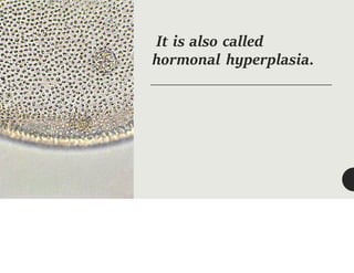 It is also called
hormonal hyperplasia.
 