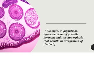 * Example, in gigantism,
hypersecretion of growth
hormone induces hyperplasia
that results in overgrowth of
the body.
 