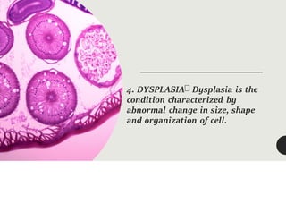 4. DYSPLASIA Dysplasia is the
condition characterized by
abnormal change in size, shape
and organization of cell.
 