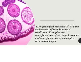 1. Physiological Metaplasia It is the
replacement of cells in normal
conditions. Examples are
transformation of cartilage into bone
and transformation of monocytes
into macrophages.
 
