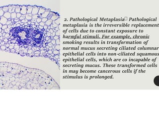 2. Pathological Metaplasia Pathological
metaplasia is the irreversible replacement
of cells due to constant exposure to
harmful stimuli. For example, chronic
smoking results in transformation of
normal mucus secreting ciliated columnar
epithelial cells into non-ciliated squamous
epithelial cells, which are co incapable of
secreting mucus. These transformed cells
in may become cancerous cells if the
stimulus is prolonged.
 