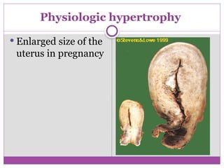 Physiologic hypertrophy
 Enlarged size of the
uterus in pregnancy
 