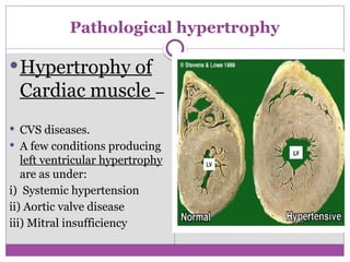 Pathological hypertrophy
Hypertrophy of
Cardiac muscle –
 CVS diseases.
 A few conditions producing
left ventricular hypertrophy
are as under:
i) Systemic hypertension
ii) Aortic valve disease
iii) Mitral insufficiency
 