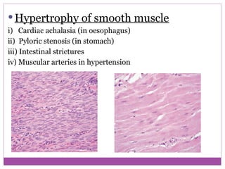  Hypertrophy of smooth muscle
i) Cardiac achalasia (in oesophagus)
ii) Pyloric stenosis (in stomach)
iii) Intestinal strictures
iv) Muscular arteries in hypertension
 