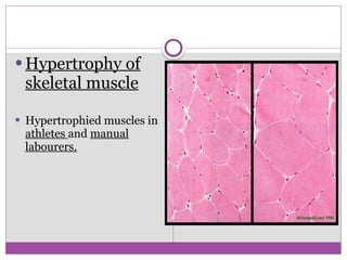  Hypertrophy of
skeletal muscle
 Hypertrophied muscles in
athletes and manual
labourers.
 