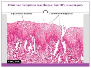 Columnar metaplasia oesophagus (Barrett’s oesophagus).
 